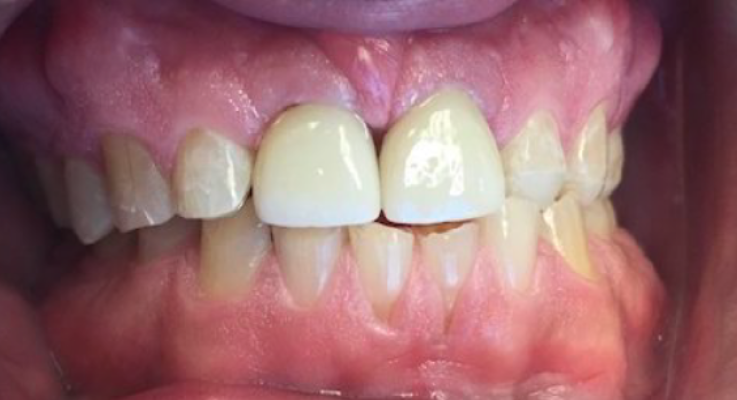 Dental implants and Invisalign after treatment